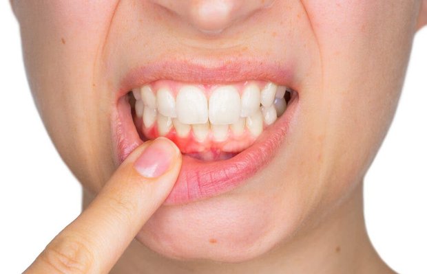 Menopoz döneminde diş eti çekilmesi kaynaklı diş kayıplarına dikkat!