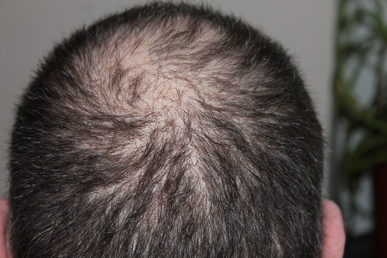 Nioxin vs Rogaine: Hangi Saç Dökülmesi Tedavisi Daha İyi?