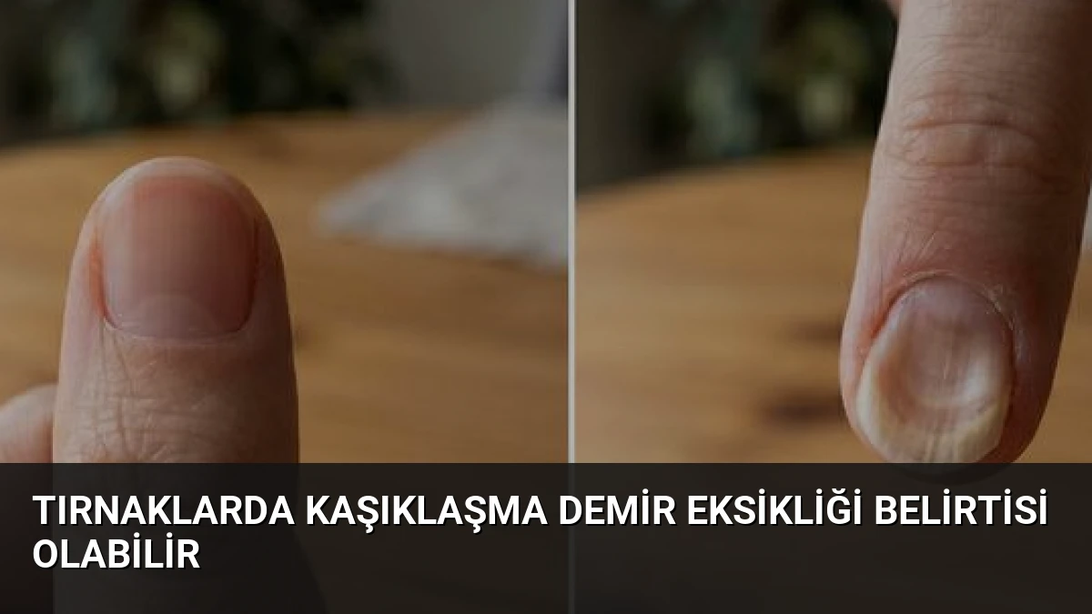 Tırnaklarda Kaşıklaşma Demir Eksikliği Belirtisi Olabilir