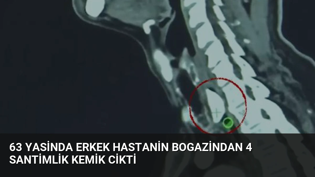 63 Yasinda Erkek Hastanin Bogazindan 4 Santimlik Kemik Cikti
