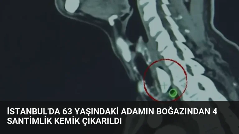 İstanbul’da 63 Yaşındaki Adamın Boğazından 4 Santimlik Kemik Çıkarıldı