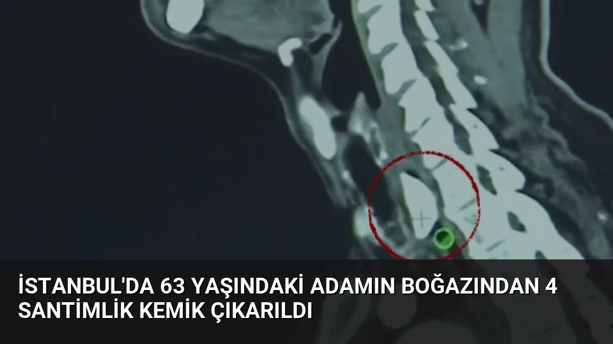 İstanbul’da 63 Yaşındaki Adamın Boğazından 4 Santimlik Kemik Çıkarıldı