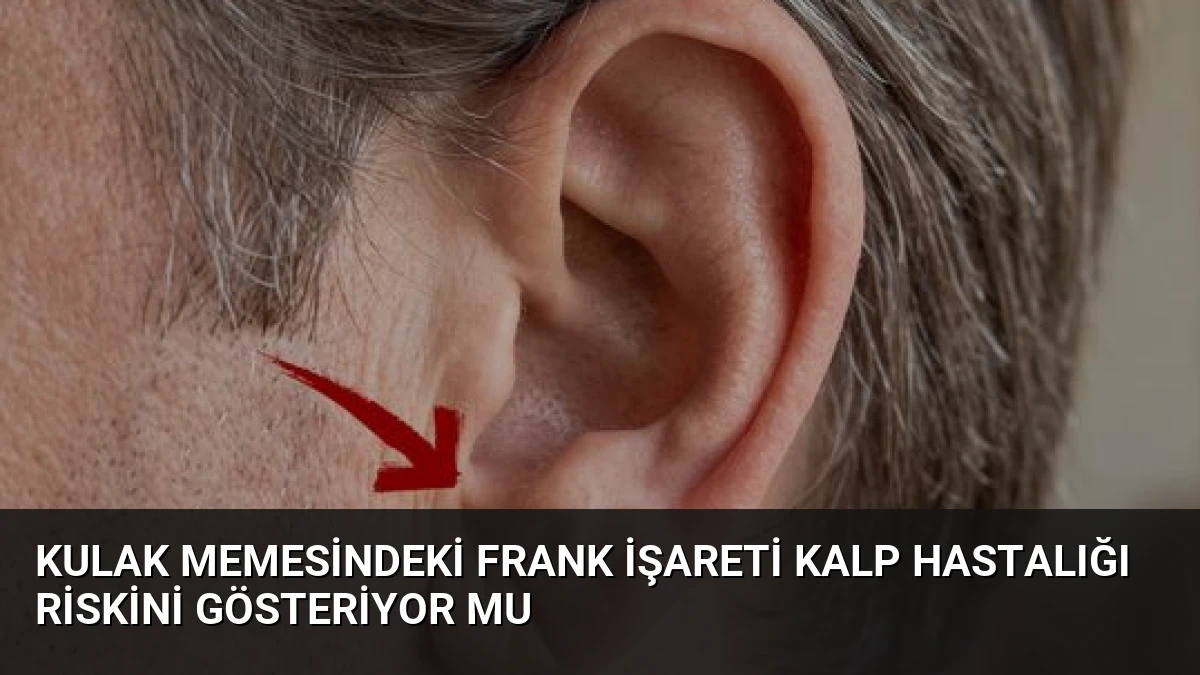Kulak Memesindeki Frank İşareti Kalp Hastalığı Riskini Gösteriyor mu