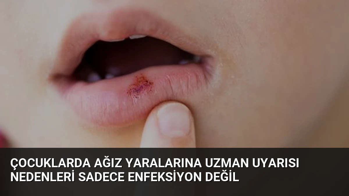 Çocuklarda Ağız Yaralarına Uzman Uyarısı Nedenleri Sadece Enfeksiyon Değil
