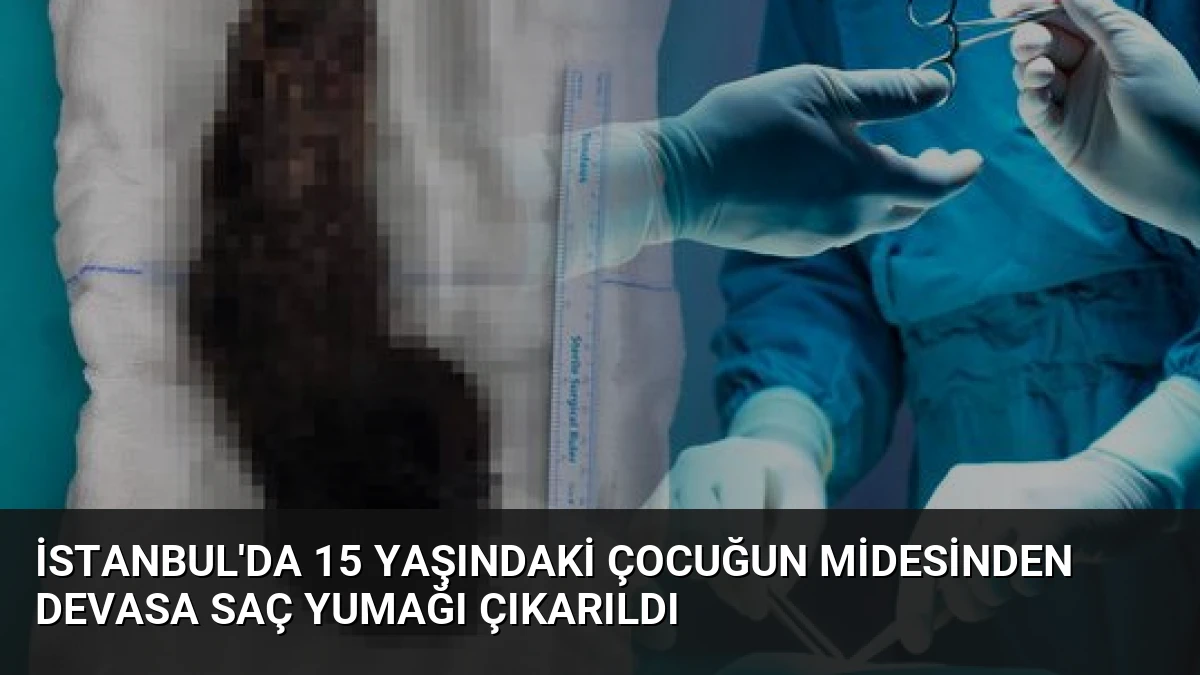 İstanbul’da 15 Yaşındaki Çocuğun Midesinden Devasa Saç Yumağı Çıkarıldı
