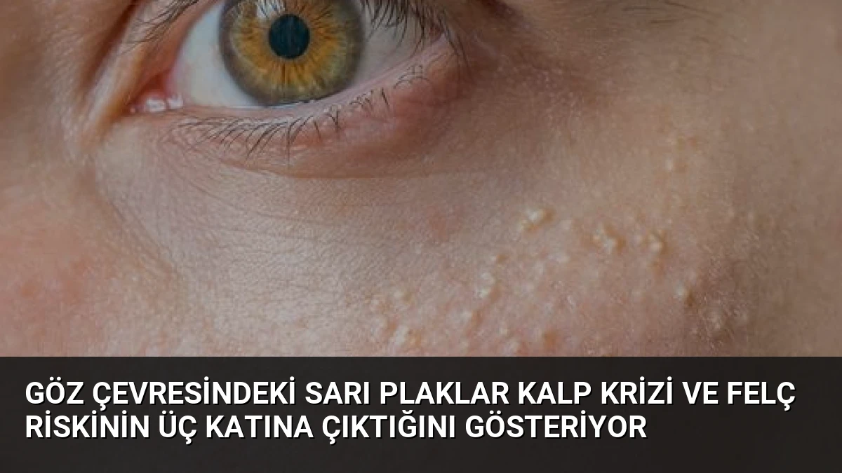 Göz Çevresindeki Sarı Plaklar Kalp Krizi ve Felç Riskinin Üç Katına Çıktığını Gösteriyor