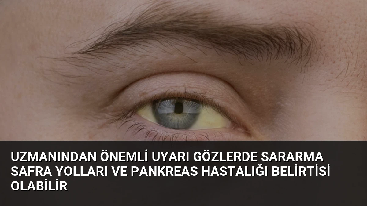 Uzmanından Önemli Uyarı Gözlerde Sararma Safra Yolları ve Pankreas Hastalığı Belirtisi Olabilir