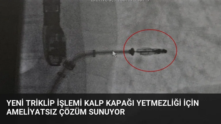 Yeni Triklip İşlemi Kalp Kapağı Yetmezliği İçin Ameliyatsız Çözüm Sunuyor