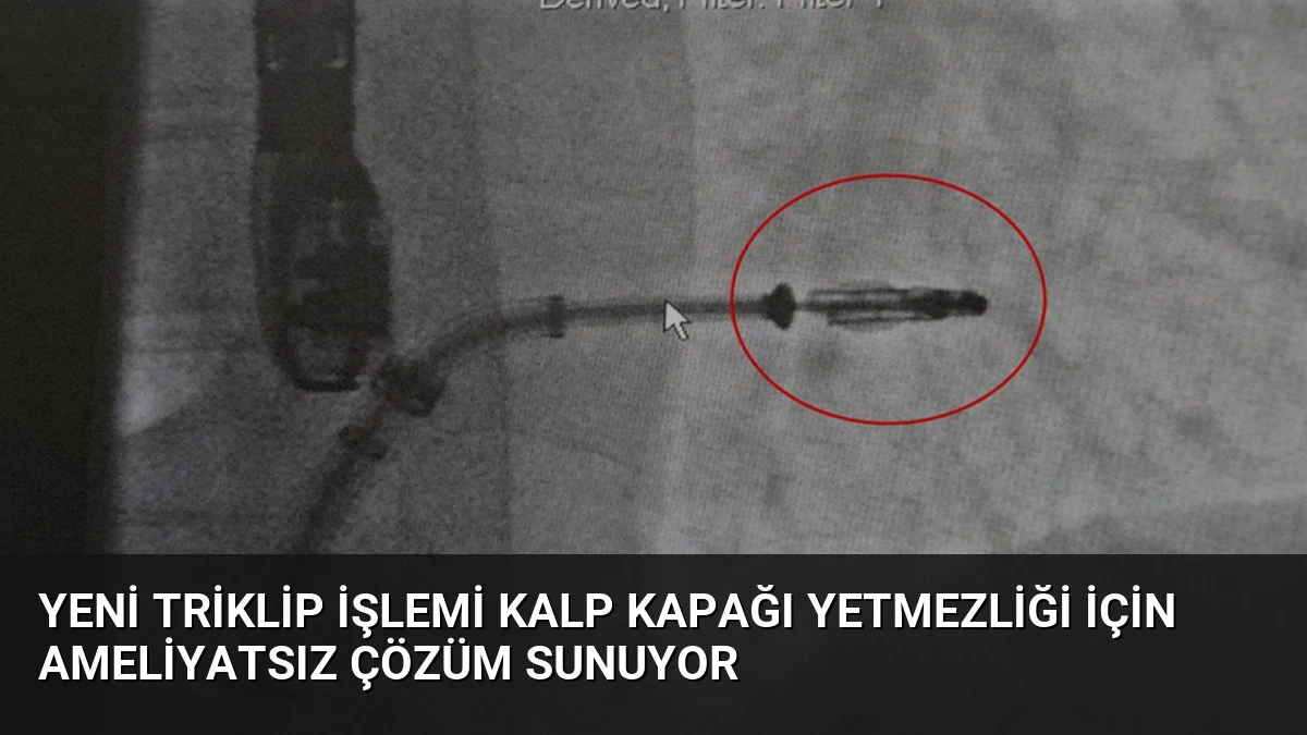 Yeni Triklip İşlemi Kalp Kapağı Yetmezliği İçin Ameliyatsız Çözüm Sunuyor